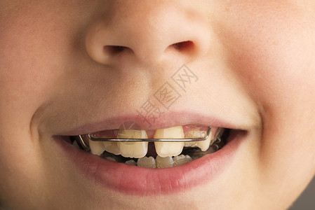穿着整牙科器以矫正牙齿姿势的微笑着微笑的小女图片