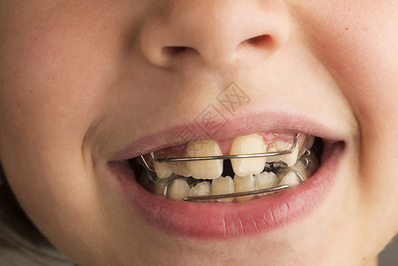 整蛊男孩穿着整牙科器以矫正牙齿姿势的微笑着微笑的小女背景
