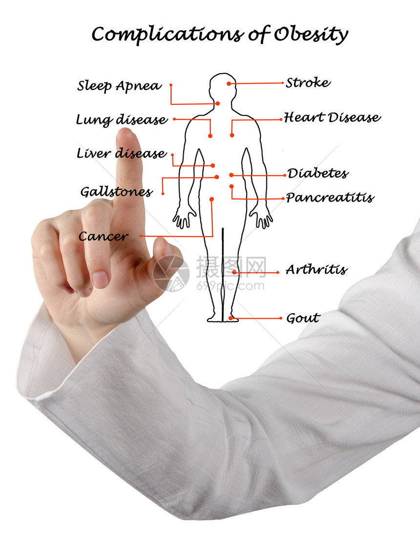 肥胖并发症示意图图片