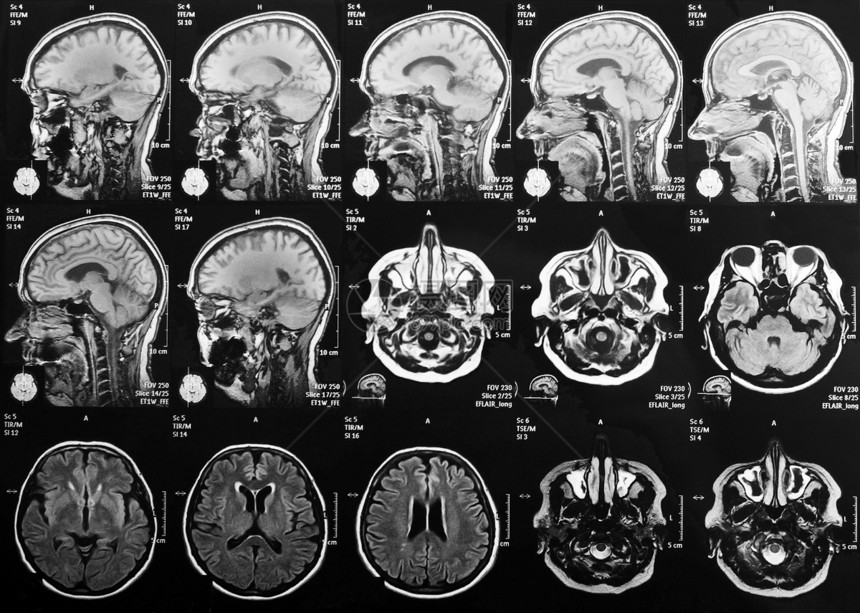 大脑的磁共振成像图片