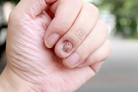 白蚁指甲感染和人体损伤手指与图片