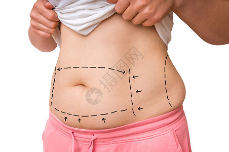 整形外科医生在病人肚子上用标记划线以图片