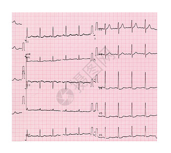 心电图ECG又名EKGElektrokardiogram图片