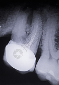 填充牙科X射线近距离图像图片