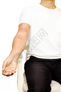 手臂上皮肤过敏皮疹的男人在白色图片