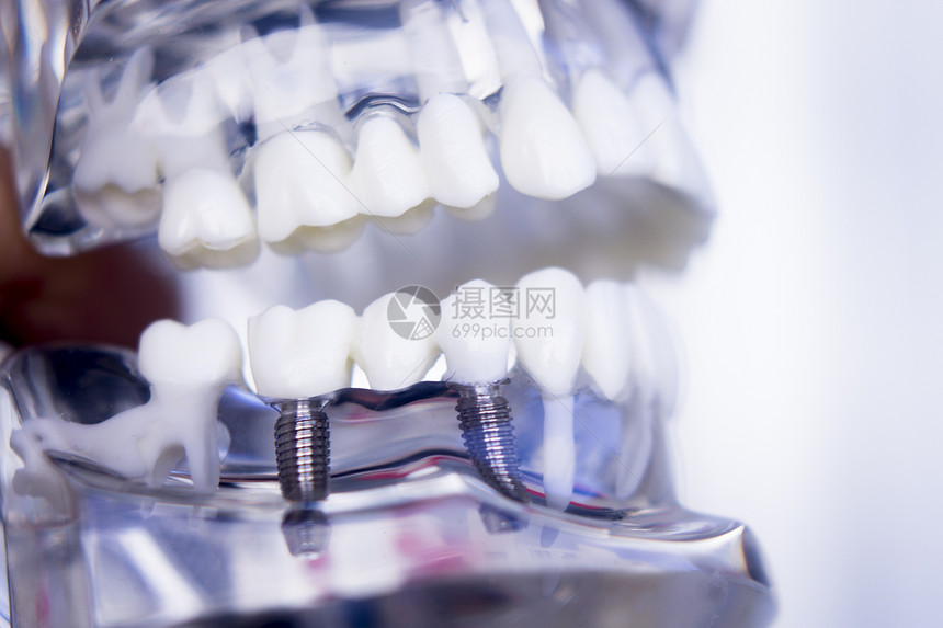 为教学习和牙科办公室显示牙齿和口香糖的病人安装螺丝植入器图片