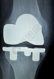 骨科膝关节半月板韧带肌腱和软骨损伤钛现代金属植入物背景图片