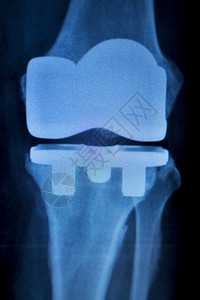骨科膝关节半月板韧带肌腱和软骨损伤钛现代金属植入物图片
