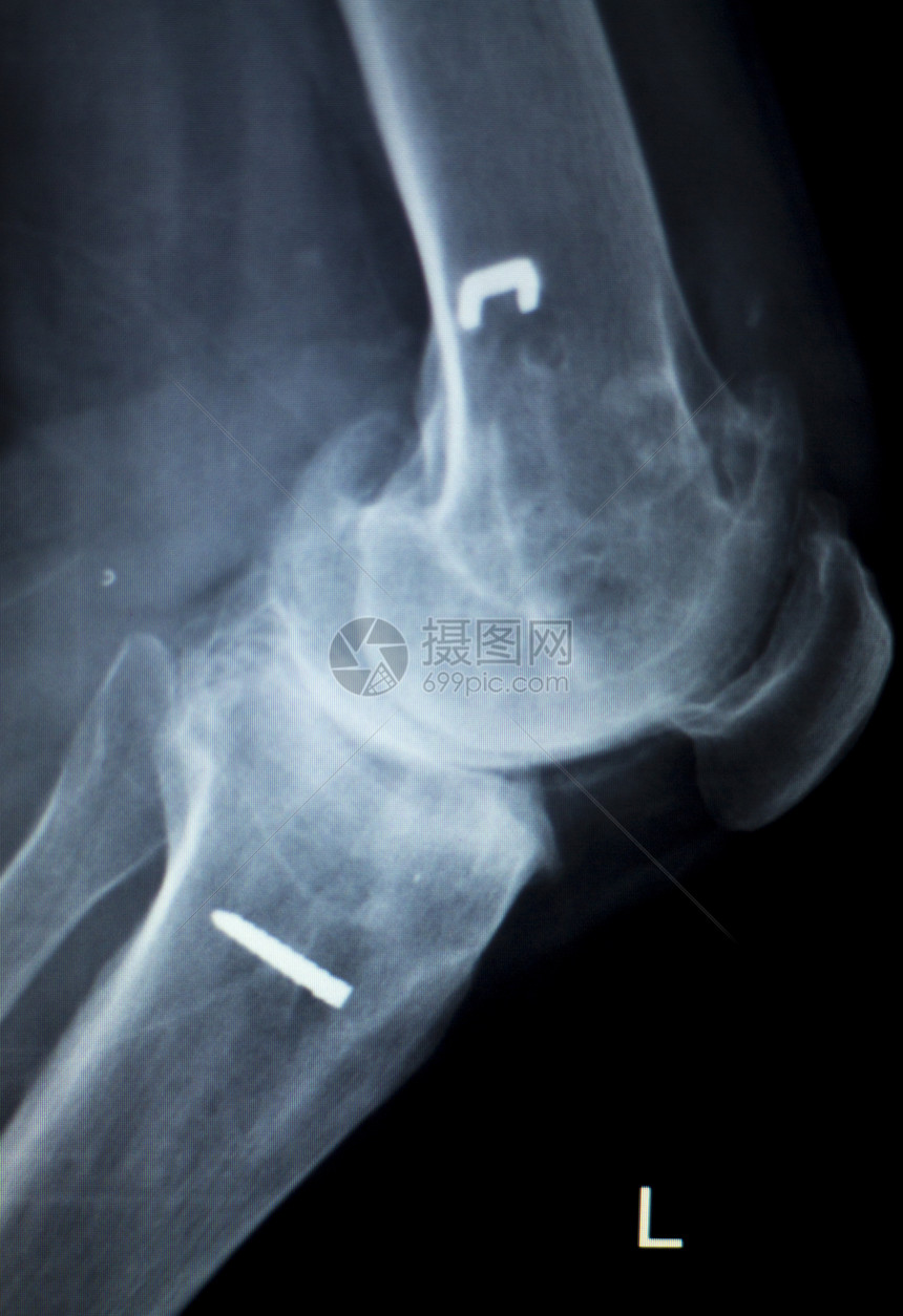 近代金属植入X射线扫描仪膝盖骨脊椎图片