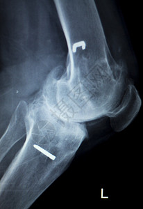 近代金属植入X射线扫描仪膝盖骨脊椎图片