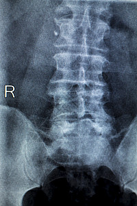 对背部疼痛低和关节炎的老年病人进行脊椎骨盆和X图片