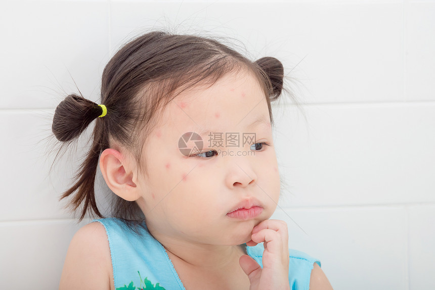 亚洲小女孩脸上被蚊子叮咬后出现红斑图片