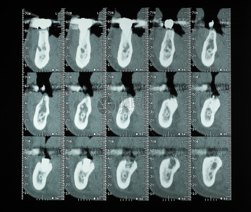 CT扫描akaCAT扫描横切截面摄影图象X图片