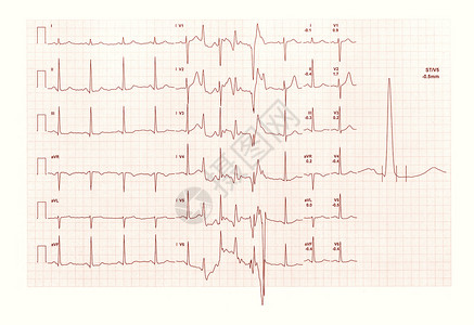 心电图ECG又名EKGElektrokardiogram图片