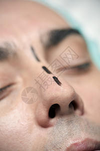 一个即将进行隆鼻手术的年轻白人男子头部的特写高清图片