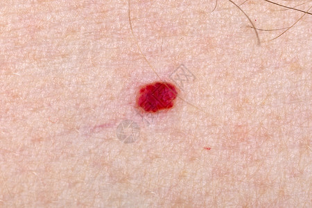 人皮肤上樱桃血管瘤的特写照片图片