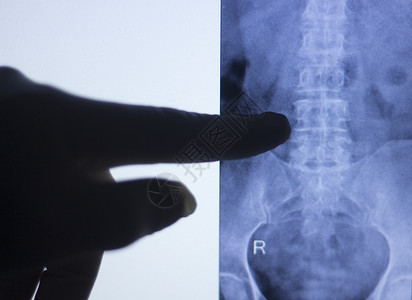 患有关节炎和关节疼痛的病人背脊椎图片