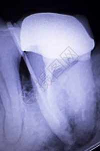 牙用冠状填充和根导管感染对牙齿进行牙科X射线测试扫描图片