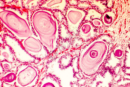 显示膨胀的腺在腺润滑液中的毛虫投射细胞放大和秘质积累的子宫变形的摄影显微背景图片