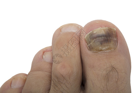 人类脚趾上的真菌感染老人脚上的牛皮癣甲真菌病是大脚趾的真菌感染图片