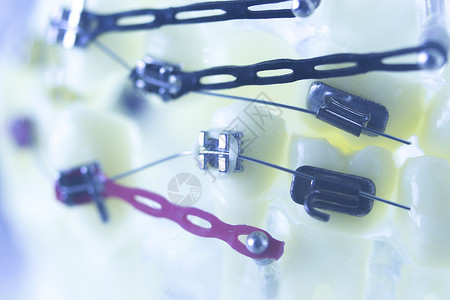 矫形牙医教授牙齿假牙模型塑料和金属括号连接器图片