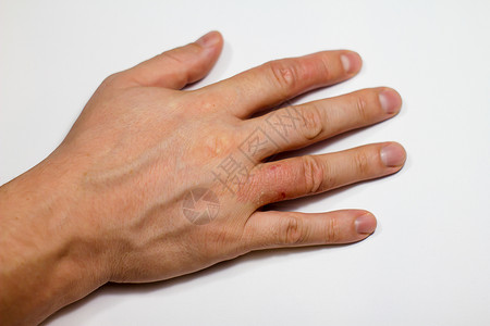 溢脂性皮炎手部皮炎白色背景上闭合的手湿疹背景