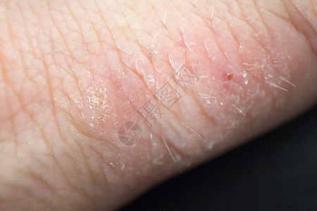 溢脂性皮炎手部皮炎白色背景上闭合的手湿疹背景
