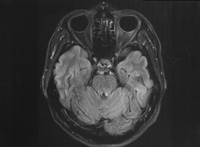 人脑磁共振成像轴向视图图片