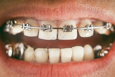 用于深咬合的牙套和牙科器具图片