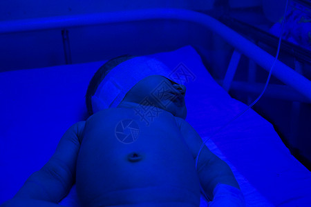 在医院治疗黄疸的新生儿光疗图片