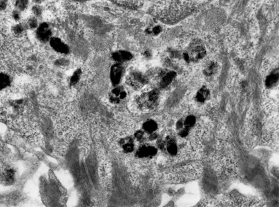 桥粒假的彩色传输电子显微镜TEM显微图显示皮肤上皮细胞中的米拉宁颗粒背景
