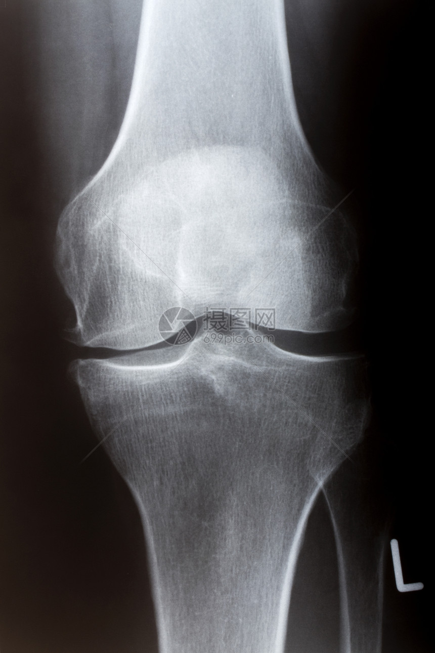 在X射线的前面的人膝盖图片