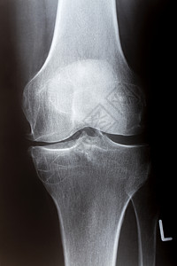 在X射线的前面的人膝盖图片