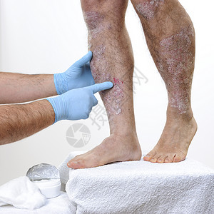 皮肤科医生用手套保护他的手研究一名成年男子腿部的炎症图片