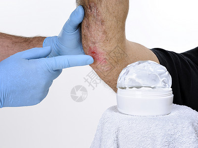 手套保护皮肤科医生研究一名成年男子右肘部患微丝虫图片