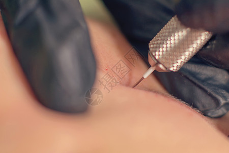 针除皱治疗针美塑疗法单针特写图片