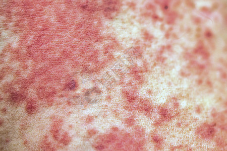 慢性荨麻疹用红色过敏皮疹关闭皮肤背景