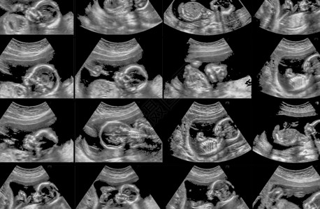 超声胎儿扫描的集合图片