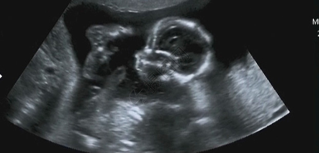 意大利实验室第四个月胎儿超声波谱学背景