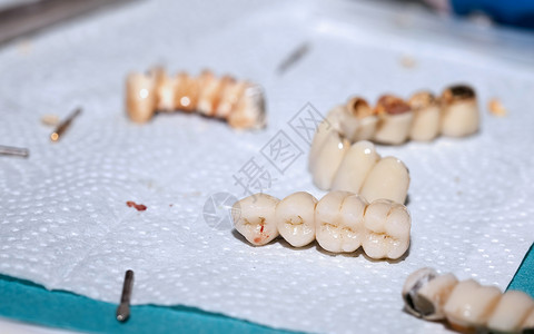 牙医的牙齿瓷修复体图片