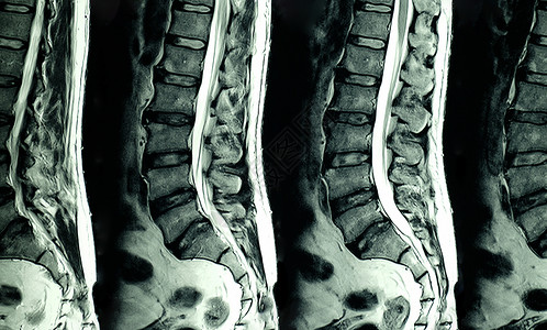 对患有慢后背疼痛的病人腰部脊椎进行核磁共振扫描图片
