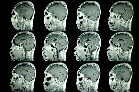 MRI脑膜炎正常信号强度的病人大脑图片