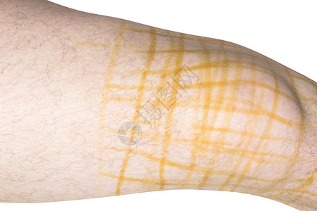 膝盖受伤后患者的腿关节脱位背景图片