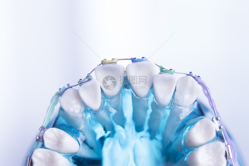 牙科保存器金属连接器括号用于在整牙科治图片