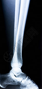 人腿的X射线X射线图像概念图片