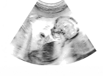 妈子宫里的婴儿的超声波图片