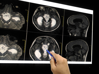 近身手部医生指向LCD监视器上的病人脑部的MRI脑部显示大脑图片