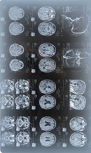 脑部核磁共振成像扫描一个老人的脑部图片