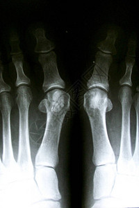 普通脚的X射线图片
