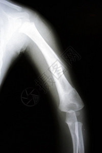 手臂断层扫描仪的x射线图像图片